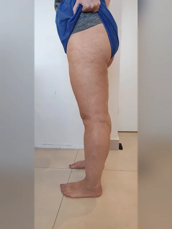 Depois: paciente 1, de perfil