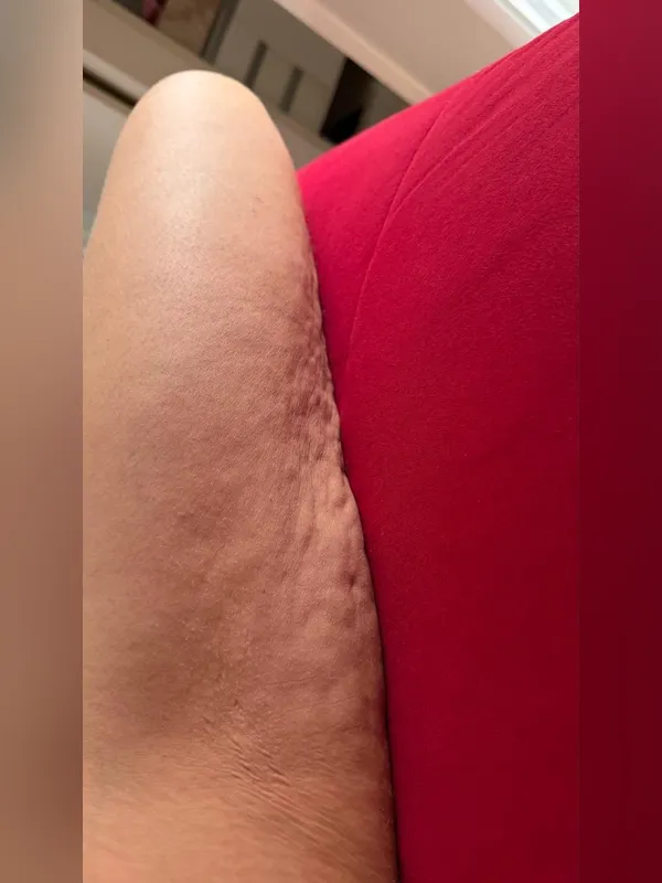 Antes: paciente 2, detalhe da coxa