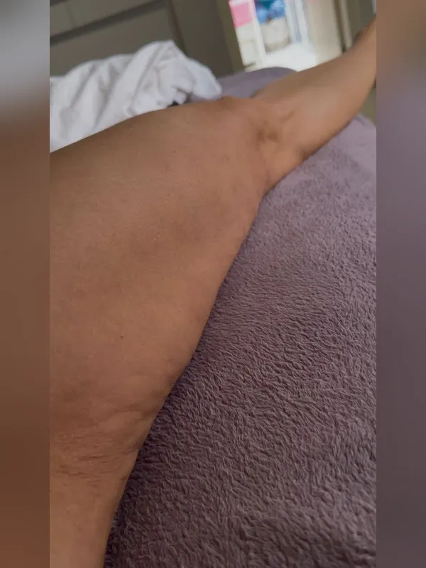Depois: paciente 2, detalhe da coxa